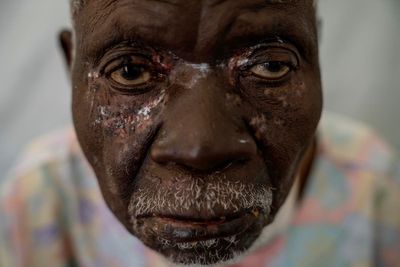 A photographer captures the mpox health crisis in Africa in a closeup