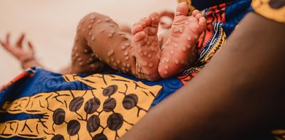 Mpox in the DRC: children are at high risk – health expert explains why