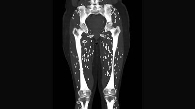 'Craziest' CT scan reveals tapeworm cysts in patient's legs; know why this happened