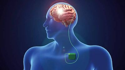How a ‘pacemaker’ for the brain fights off Parkinson’s