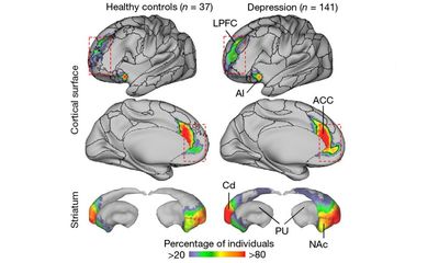 Part of brain network much bigger in people with depression, scientists find