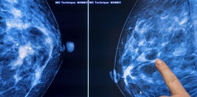 Breast density and mammograms: New FDA rule will ensure all women have more information after cancer screenings