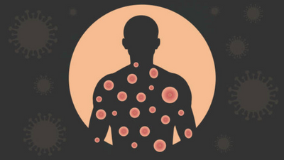Understanding monkeypox: Myths and misinformation to ignore about the disease