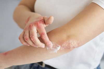 Eli Lilly's Eczema Drug Gets FDA Approval, Injectable Treatment Available Within Weeks