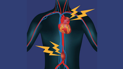 Acute aortic dissection: All about this critical life-threatening disorder of the heart