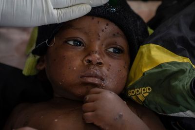 A gold mining town in Congo has become an mpox hot spot as a new strain spreads