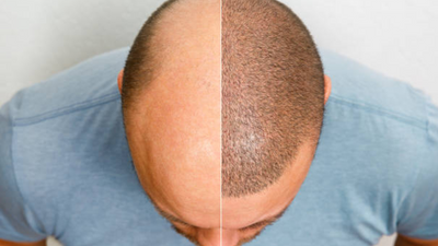 Essential post-hair transplant surgery tips for smoother recovery
