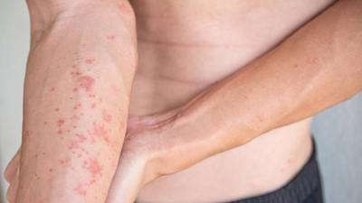 Scratching beyond the surface: Here’s all you need to know about Atopic Dermatitis