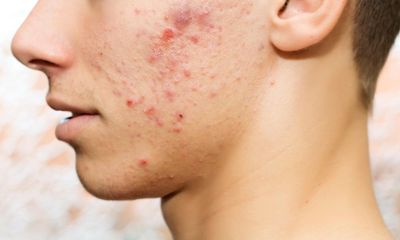 Acne rates in UK adolescents and young adults among highest in the world