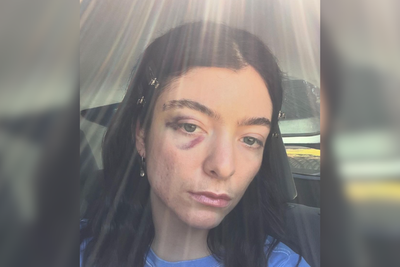 Lorde fans express concern after singer shares selfie with black eye