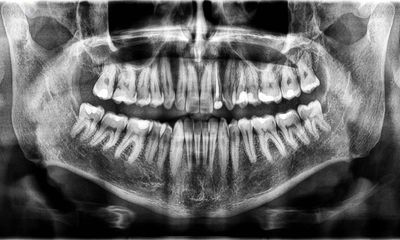 Tara lost her teeth ‘one by one’ and can barely eat. She’s not alone, an Australian dental study says