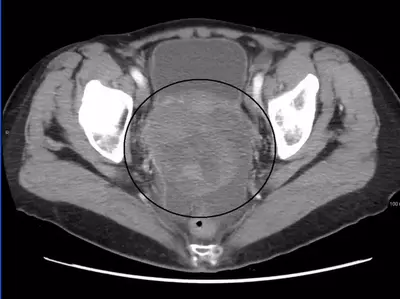 Ovarian cancer vaccine: What you need to know about breakthrough jab that could wipe out disease