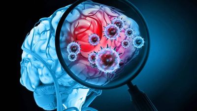 World Meningitis Day 2024: What is meningitis, the deadly brain infection? Know signs and symptoms