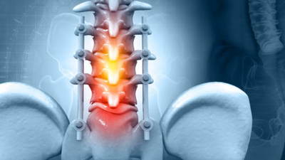 Uncover the surprising symptoms of Spinal Stenosis before it's too late