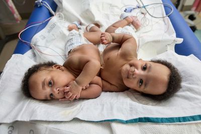 Twins born conjoined celebrate 1st birthday after separation surgery