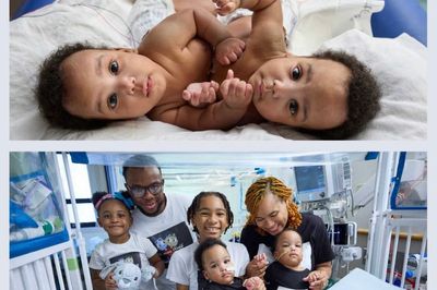 Conjoined twins are successfully separated at Philadelphia hospital, ready to sleep in their own beds