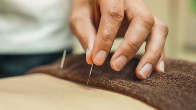 Acupuncture really works for sciatica pain, study finds