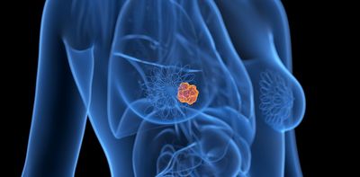 Breast cancer: why it’s difficult to treat and what new approaches are on the horizon