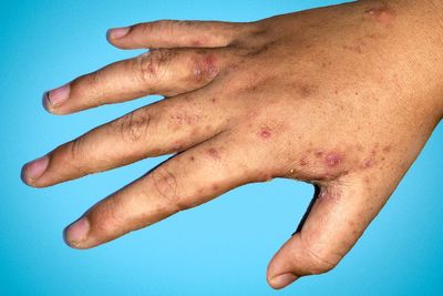 GPs report rise in scabies cases as public warned not to ignore potential symptoms