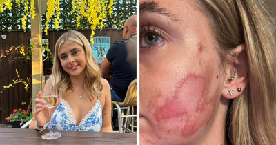 “Horrific”: Woman Suffers Second-Degree Burns After Getting Popular Beauty Procedure