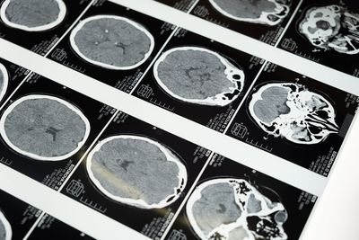 Understanding Traumatic Brain Injuries: Symptoms, Treatment, and Legal Rights