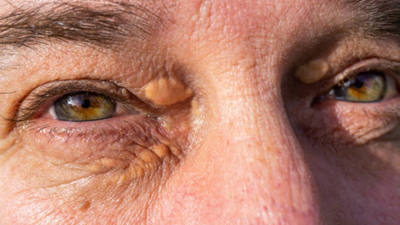 Are eyelid bumps a hidden danger? Know what it means for the heart health