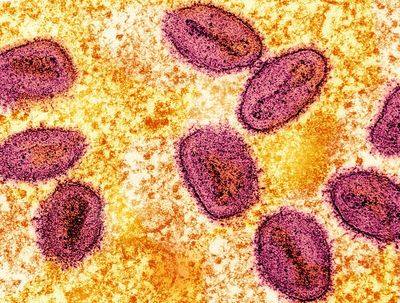 First case of new potentially deadly mpox strain Clade 1b detected in UK