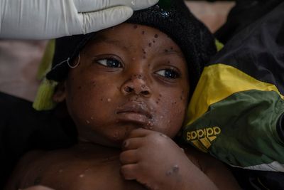 Mpox cases in Congo may be stabilizing. Experts say more vaccines are needed to stamp out virus