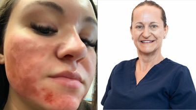 TikToker Suffers Chemical Facial Burns After Undergoing Microneedling, Esthetician Speaks Out