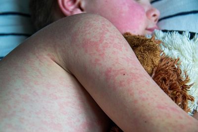 Cases of highly infectious and preventable measles surged across the globe by 20 percent last year