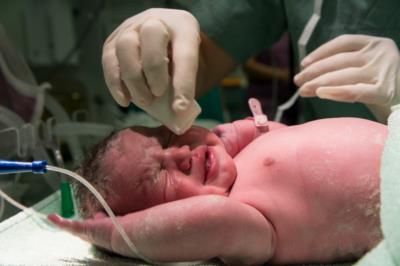 US Faces High Preterm Birth Rates, Racial Disparities Persist