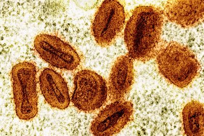 First US case of severe mpox strain reported in California