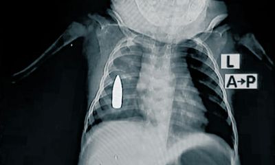 X-rays show shrapnel and bullets buried in children caught in Sudan war