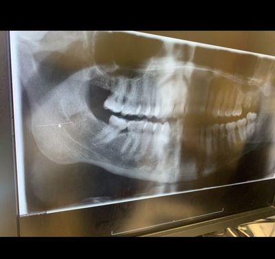 Dad receives payout after dentist’s needle snaps off and becomes lodged in mouth