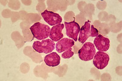 Hope for blood cancer patients as new Car-T treatment shows promise in UCL trial