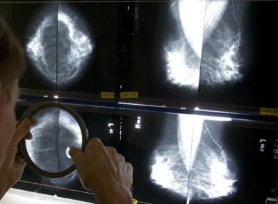 Studies Show Some Breast Cancer Patients Can Avoid Surgeries