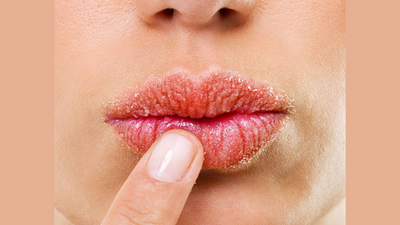 Chapped lips and skin cracking: Tips for preventing winter dryness