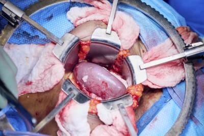 Alabama Woman Receives Successful Pig Kidney Transplant