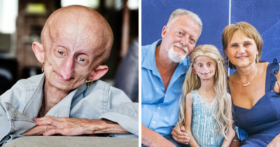 Teen Who Aged 8 Times Faster And Dreamed Of Marrying Passes Away Before Christmas