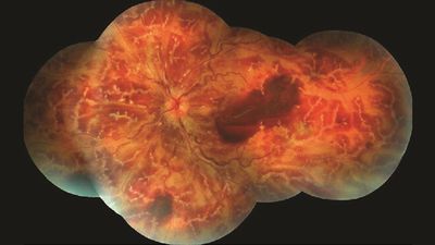 Frosted branch angiitis: A rare eye condition that makes the retina look like a frosted tree