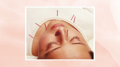 Is facial acupuncture really 'natural Botox'? Here's what to know before booking