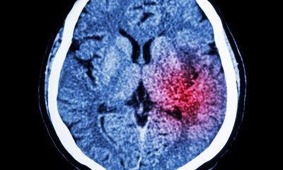 Algorithm could help prevent thousands of strokes in UK each year