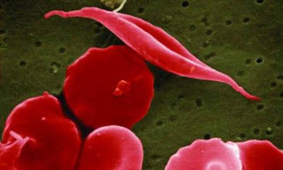 NHS error meant hundreds of parents did not know children’s sickle cell status