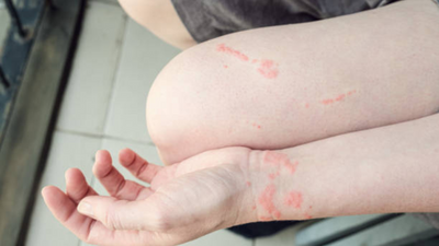 Jellyfish sting: When does it become deadly?