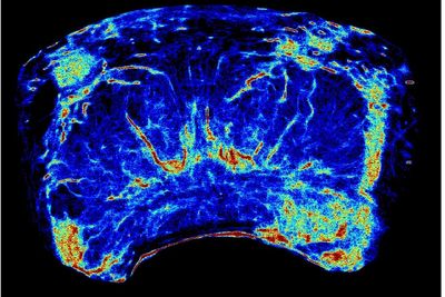 New prostate cancer imaging shows ‘extremely encouraging’ results in trials