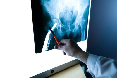 Streeting urged to honour promise to end osteoporosis service postcode lottery