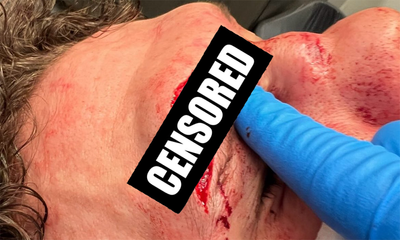 Dana White shares gnarly images of UFC Fight Night 249 winner’s cut