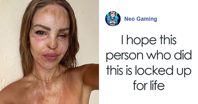 “So Cowardly”: Katie Piper Announces ‘End Of The Road’ Health Update 16 Years After Acid Attack