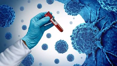 ​Cancer cases surge in young; simple lifestyle changes to lower your risk