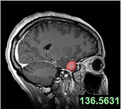 Watch: Tumour in mother-of-three's head removed through eye socket in groundbreaking operation